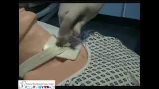 Removal of Tracheostomy Speaking Valves and Inner Tubes [upl. by Ykceb]