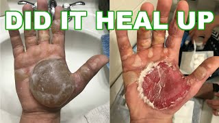 Second 2nd Degree Burn Treatment At Home How To Treat A Burn Blister At Home [upl. by Leilani622]