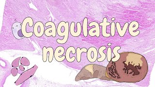 Coagulative necrosis  general pathology [upl. by Lenad561]