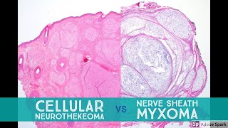 Cellular Neurothekeoma vs Nerve Sheath Myxoma  Dermpath Lookalikes [upl. by Neelyahs]