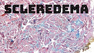 Scleredema firm hard thick skin on upper back with colloidal iron mucinmyxoid stain [upl. by Namrac]