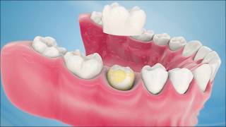 Dental Crown Procedure [upl. by Alejo]