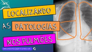 Pulmões no RX  Parte 22  Como localizar as patologias no RX [upl. by Secnirp]