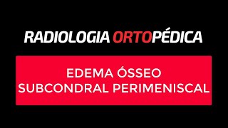 Edema Ósseo Subcondral Perimeniscal [upl. by Ahsitahs627]