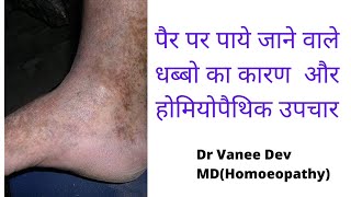 Homoeopathic treatment of Schamberg diseasehomoeopathic medicines for dark spots on leg [upl. by Irvin]