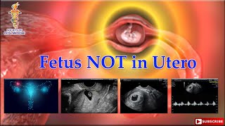 Fetus NOT in Utero [upl. by Creath]