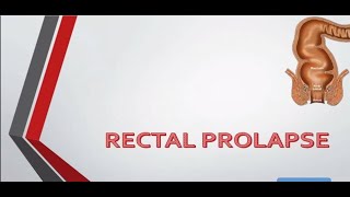 Rectal Prolapse causes and treatment – General Surgery Lecture [upl. by Brittain343]