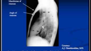 X Ray CHEST LORDOTIC VIEW How to do CHEST LORDOTIC Projection chestxray radiographer chest [upl. by Aneer531]