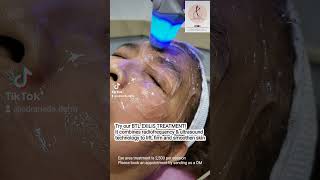 Effective nonsurgical eyebag removal and drooping eyelid treatment using BTL Exilis [upl. by Faustine965]