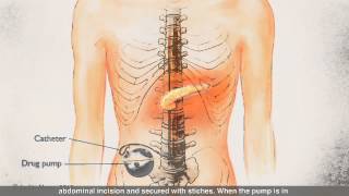 Intrathecal Pump for Pancreatic Cancer Pain Management [upl. by Nivla379]