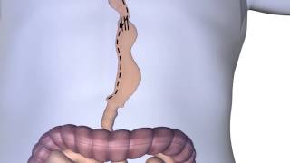 Esophagectomy Procedure Animation [upl. by Marashio480]