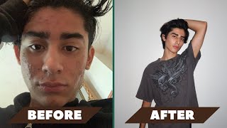 My Accutane journey [upl. by Aynatan628]