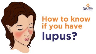 Systemic Lupus Erythematosus SLE Symptoms Diagnose And Treatment  Rheumatology [upl. by Sissy]