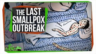 The Last Major Smallpox Outbreak in America [upl. by Nivle]