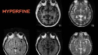 COVID19 Watershed Stroke Patient [upl. by Trotter]