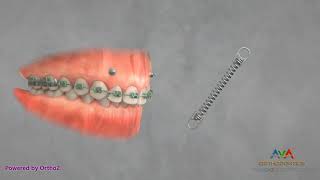 Orthodontic Treatment for Gummy Smile  TAD and Coil Spring [upl. by Robbert359]