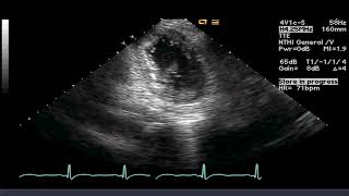 TTE  LV diverticulum [upl. by Ettezzus]