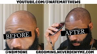 How To Get Your Hairline Back  From Bald To Edge Up  Hairline Restoration [upl. by Idelia]