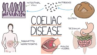 Understanding Coeliac Disease [upl. by Muldon]