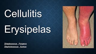 Cellulitis Erysipelas lecture penicillin V drug skin infection USMLE medical Roze pharm [upl. by Seamus]