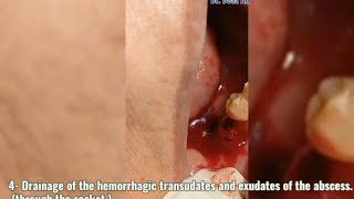 How to manage acute exacerbation of chronic periapical abscess [upl. by Grochow]