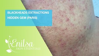 Blackheads Extraction Hidden Gem Paris [upl. by Tarsuss]