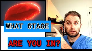 Decoding Hemochromatosis Stages [upl. by O'Carroll]