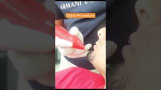 Cautery for Warts and Mole  Dr  Aftab Afzal  Aesthetics Lounge Islamabadbeauty skincare [upl. by Fabrianna]