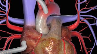 KoronararterienBypass CABG [upl. by Tiffanle]