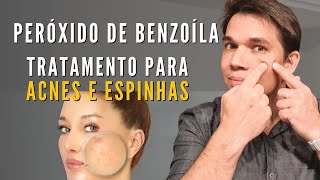 Peróxido de Benzoíla Como usar para acabar com a acne [upl. by Shippee]