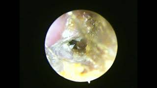 Grade 3 External Auditory canal Exostosis [upl. by Ennazus559]