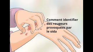 Comment identifier des rougeurs provoquées par le sida [upl. by Einhpets]