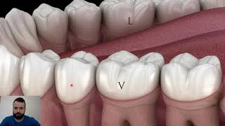 Instrumentais periodontais raspagem supragengival e subgengival [upl. by Clevie]