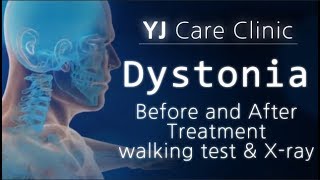 Dystonia patients  Before and after treatment  walking test  xray  사경증환자 치료전후 비교  근긴장이상증 [upl. by Morse]