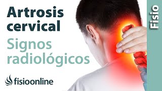 Artrosis cervical  Signos radiológicos [upl. by Fesoy]