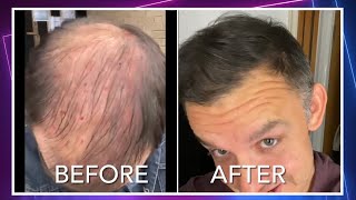 I had PRP platelet rich plasma therapy for hair loss instead of a hair transplant Part 1 [upl. by Mayhew]