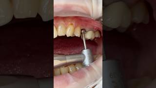 임플란트 세멘리스보철 dental dentist implantdentist cementless [upl. by Gnay654]