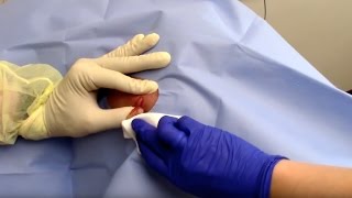 Abscess Drainage Performed by Dermatologist Dr David Myers [upl. by Ajak56]