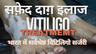 BEST VITILIGO SURGERY IN INDIA  भारत में सर्वश्रेष्ठ विटिलिगो सर्जरी  VITILIGO PIGMENTOZ PROCESS [upl. by Tarton]