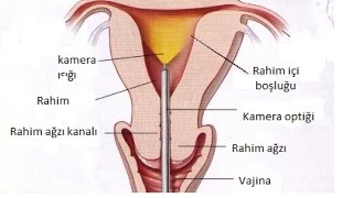 Histeroskopi  Op Dr Emre Karatekelioğlu [upl. by Hogg]