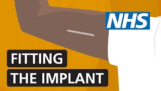 Fitting the contraceptive implant  NHS [upl. by Gombach]