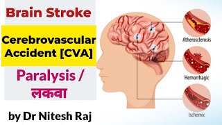 StrokeBrain StrokeBrain haemorrhageParalysisलकवा drniteshraj [upl. by Clorinda]