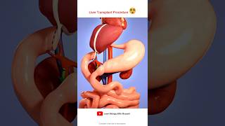 Liver transplant Procedure Animation Video [upl. by Aokek731]