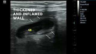 Cholecystitis [upl. by Carlyle]