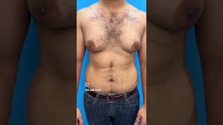 Gynecomastia Surgery Results lahore gynecomastia pakistan [upl. by Alimak]