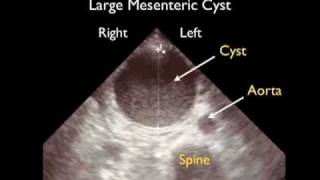 How To Aorta Ultrasound  Aneurysms Case Study Video [upl. by Hailee621]