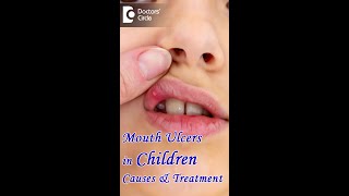 Mouth Ulcers in Children Causes amp Treatment  Dr K Saranya Doctors Circle shorts [upl. by Mitchel975]