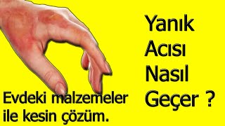 Yağ Yanığı Nasıl Geçer [upl. by Yancey]