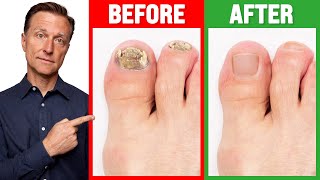 The REAL Cause of Toenail Fungus is [upl. by Ardnuaet690]