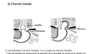 SEMIOLOGIE CHIRURGICALE Sémiologie œsophagienne et gastrique [upl. by Rozamond]